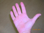 Muscle Atrophy and Weakness in Hand and Fingers Due to Pinched Ulnar Nerve